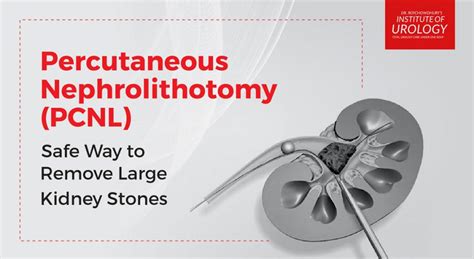 Percutaneous Nephrolithotomy Institute Of Urology