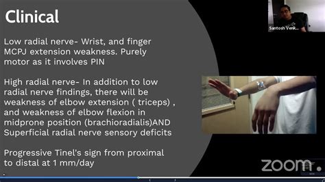 Radial Nerve Palsy For Frcs Orth Youtube
