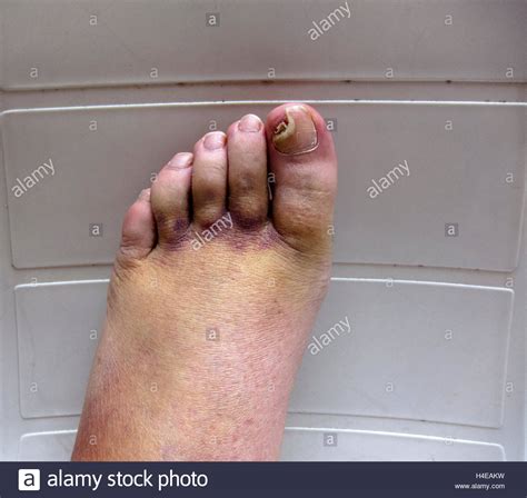 Broken Ankle Bruises And Swelling On Foot And Toes After Cast Stock