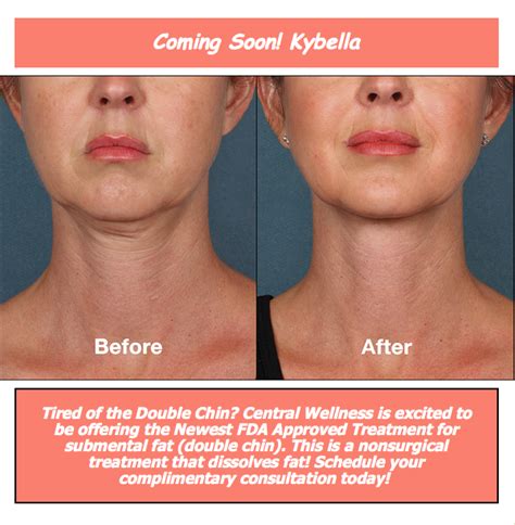 Kybella Laser Clinics Botox Fillers Double Chin Makes You Beautiful