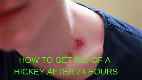 How To Get Rid Of A Hickey After 24 Hours Youtube