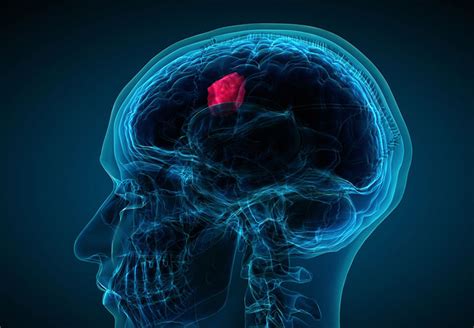What Are The Actual Warning Signs Of A Brain Tumor Cleveland Clinic