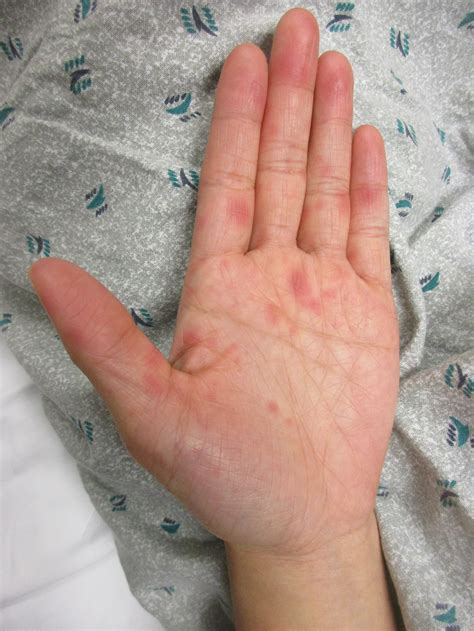 A Y O Asian Woman Presents With A Rash On Her Palms And Soles Everyday E B M