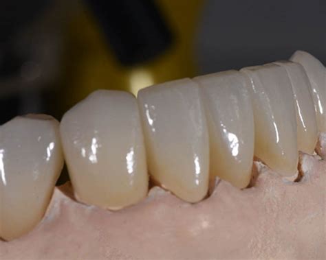 All Ceramic Dental Restorations