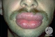 Keep head elevated & choose the right position. » How to Treat a Swollen Lip