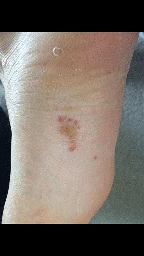 The Blister On My Foot Looks Like A Foot Mildlyinteresting