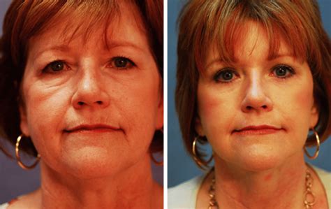 Face And Neck Lift 1 Before And After Photos Aventura Fl