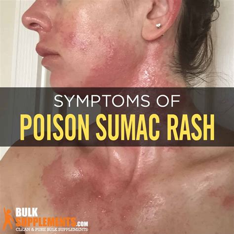 Poison Sumac Leaf Scars