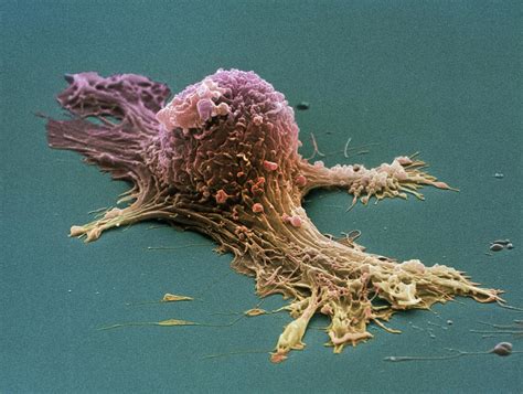 Ovarian Cancer Cell Sem Photograph By Steve Gschmeissner Fine Art