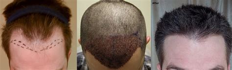 Hairline Lowering Temple Recession Enhancement Alviarmani Hair