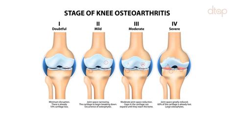 Symptoms Of Knee Osteoarthritis