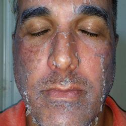 Check spelling or type a new query. The Chemical Peel Process, As Told by a Plastic Surgeon ...