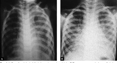 Figure 1 From Congenital Pulmonary Lymphangiectasia With Chylothorax