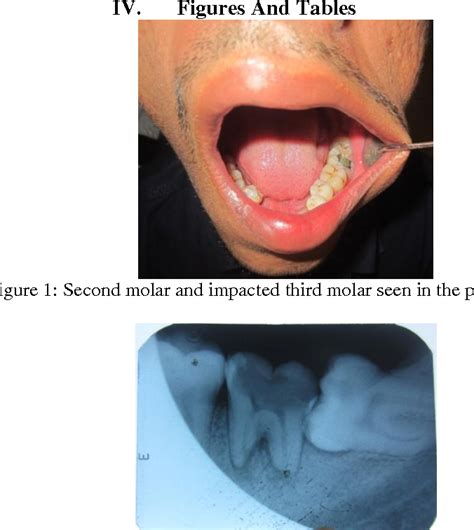 Figure 1 From Autotransplantation Of Impacted Third Molar With