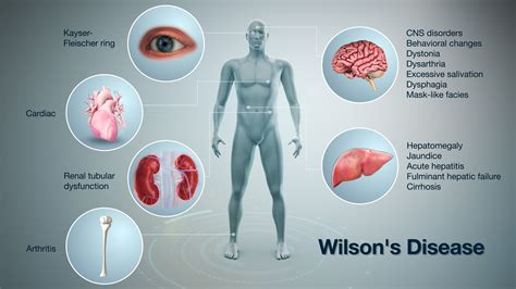 Wilsons Disease Depicted By A 3d Medical Animation Still Shot