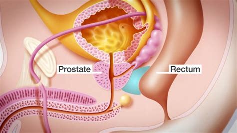 Prostate Gel Spacer Reduces Bowel And Bladder Damage Bbc News