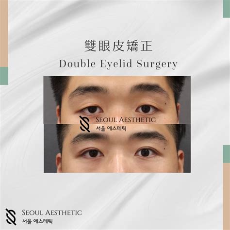 Double Eyelid Surgery Case Study Seoul Clinic Seoul Aesthetic
