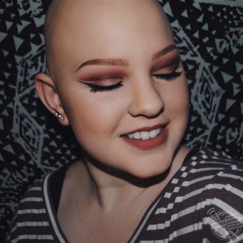 After Hiding Her Bald Head For 11 Years This Brave Alopecia Sufferer Is Finally Happy To