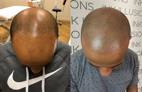 What Is Scalp Micropigmentation Ink Illusions