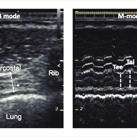 Ultrasound Of The Right Parasternal Intercostal Muscle Left The