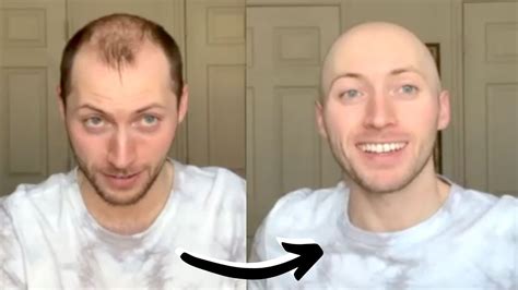 Balding To Bald Head Shave Glow Up In My 20 S Youtube