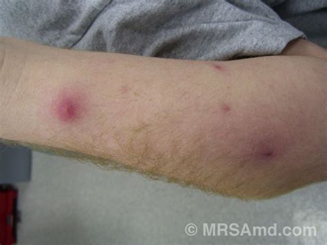 Mrsa Pictures Staph Infection Picturesgraphic Images Mrsa Md