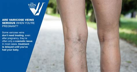 Varicose Veins During Pregnancy The Complete Guide
