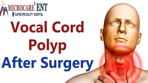 Vocal Cord Polyp After Surgery Microcare Ent Hospital Youtube