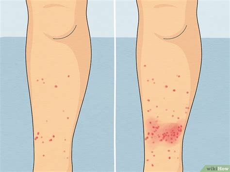 How To Treat Sand Flea Bites Soothe Itchy Irritated Skin Fast