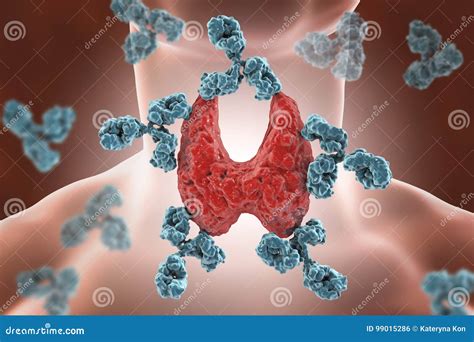 Thyroiditis Autoimune Doença Do ` S De Hashimoto Ilustração Stock