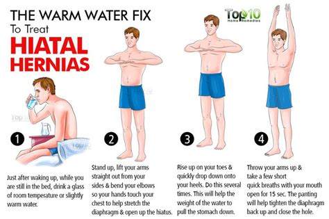 home remedies for hiatal hernias top 10 home remedies holistic health remedies recovery