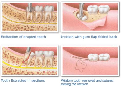 Here When To Take Antibiotics After Wisdom Tooth Extraction Tooth