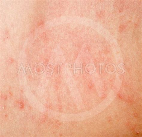 Allergic Rash Dermatitis Sk By Xunbin Pan Mostphotos