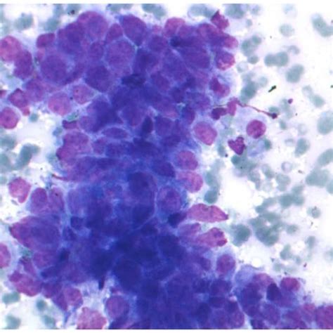Mediastinal Lymph Node Cytology Of A Nsclc Patient Microscopical