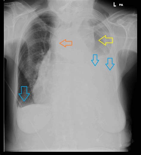 Aortic Dissection Chest X Ray Wikidoc