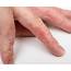Eczema And Skin Allergy > Dr Health Clinic