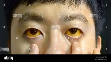 esclerótica del ojo fotografías e imágenes de alta resolución alamy