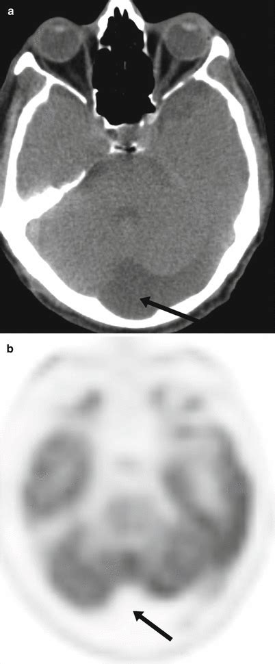 Normal Variants And Benign Findings Radiology Key