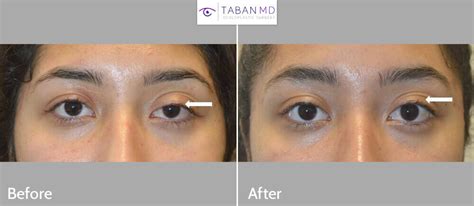 Eyelid Ptosis Before And After Gallery Taban Md