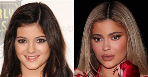 Did Kylie Jenner Get Plastic Surgery See Transformation
