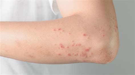 Skin Bumps Different Types Causes And More Healthkart