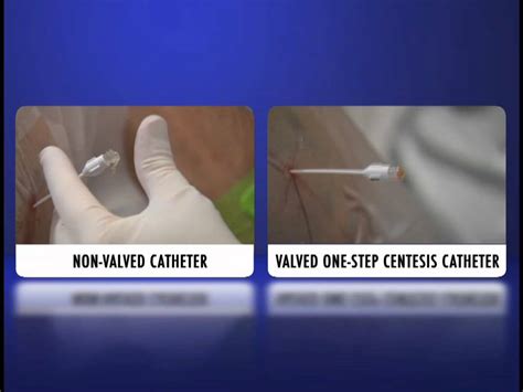 Valved One Step Centesis Catheter Actual Video Youtube