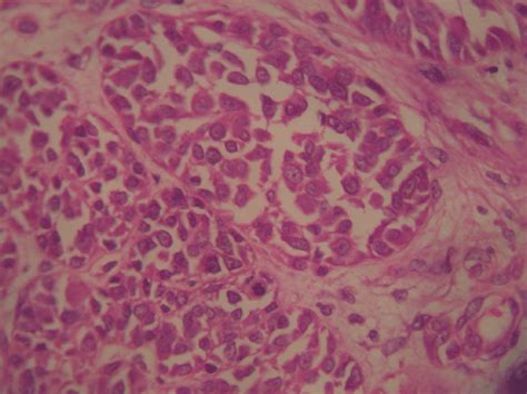 A Histopathology Of The Lesion Was Consistent With Malignant Melanoma
