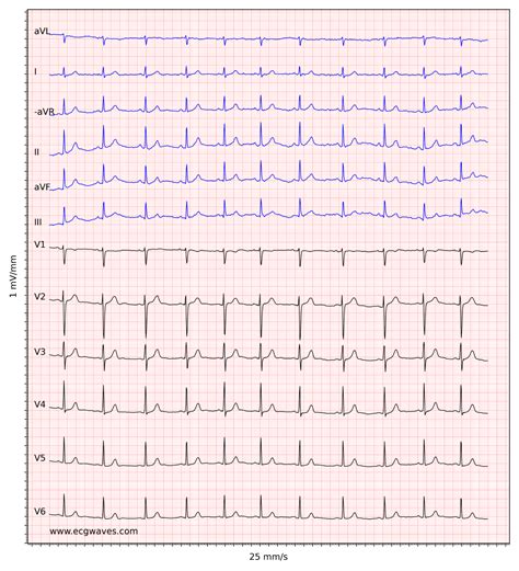 ECG Interpretation Characteristics Of The Normal ECG P Wave QRS Complex ST Segment T Wave
