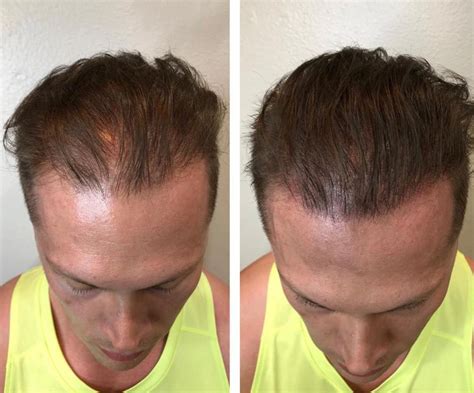 Scalp Micropigmentation Las Vegas Hides Thinning Hair And Receding