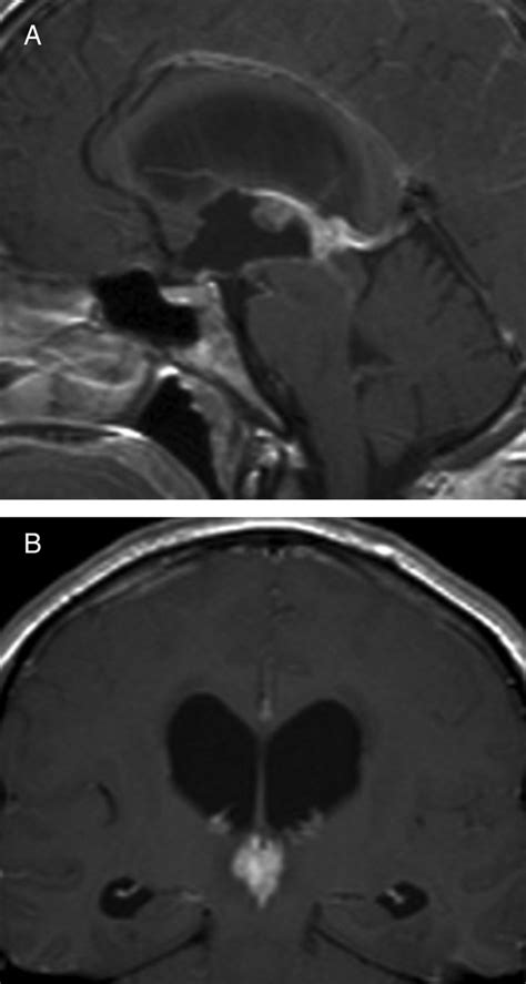 Unusual Behaviour Of A Pineal Germinoma Mimicking Neurosarcoidosis And