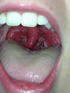 What throat cancer look like. Do You Need to Replace Your Toothbrush After Strep Throat ...