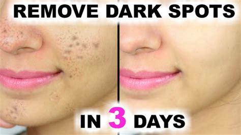 remove dark spots in 3 days potato juice lemon juice youtube