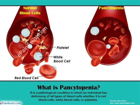 What Is Pancytopeniacausessymptomstreatment