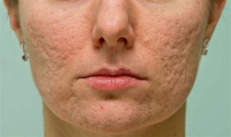 Rolling Acne Scars Causes And Solutions Celevenus Wellness